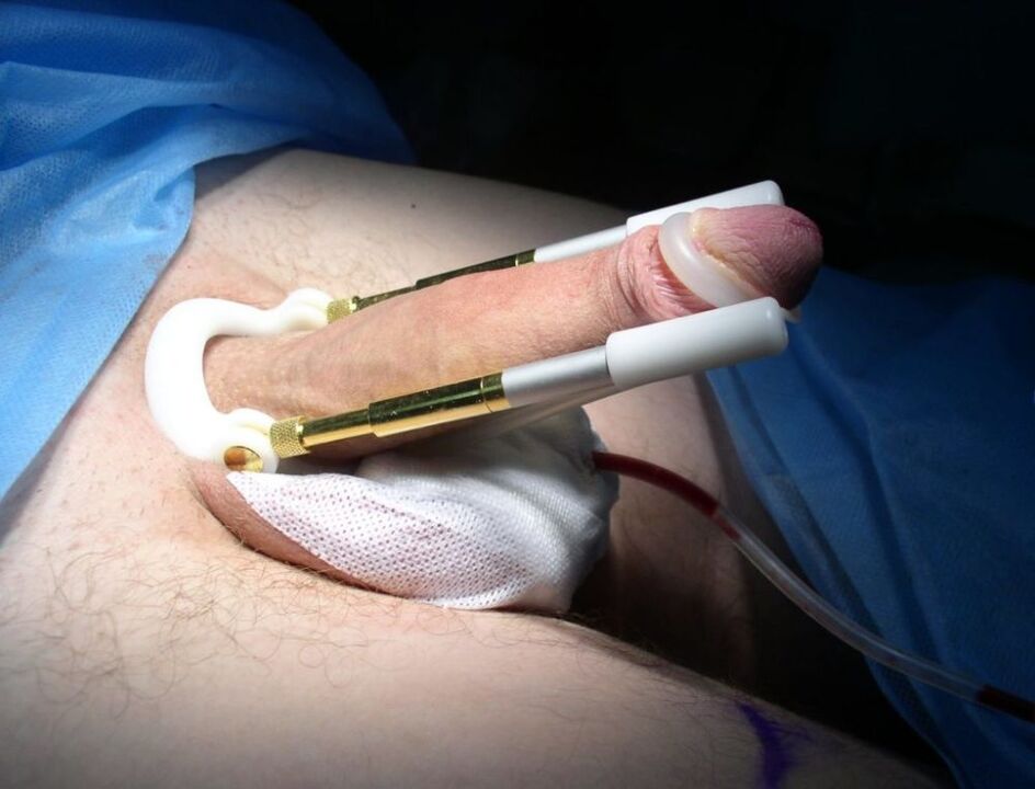 nošenje podaljška po operaciji