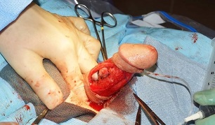 operacija povečanja penisa