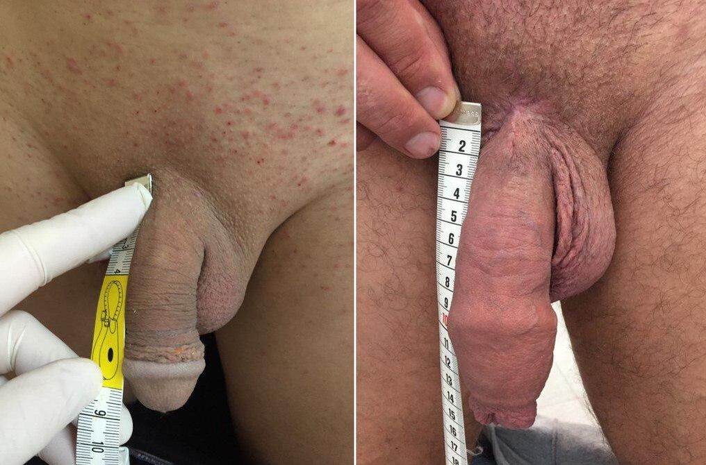 pred in po operativni povečavi penisa