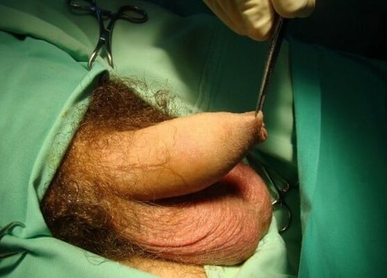 operacija za povečanje penisa